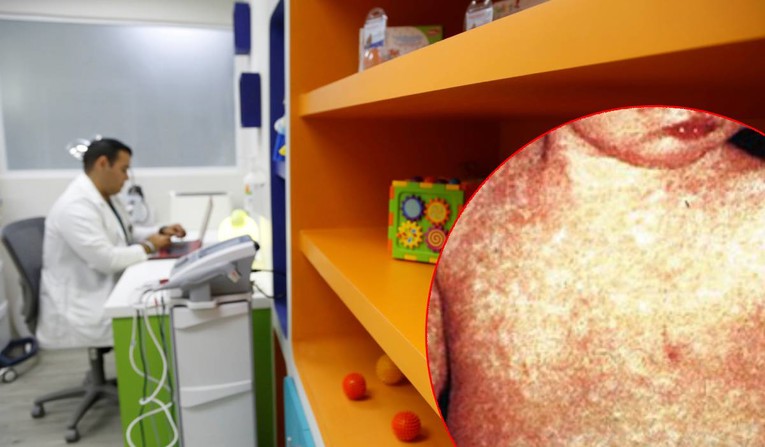 Dvije bebe premlade za cijepljenje zaražene ospicama u Australiji